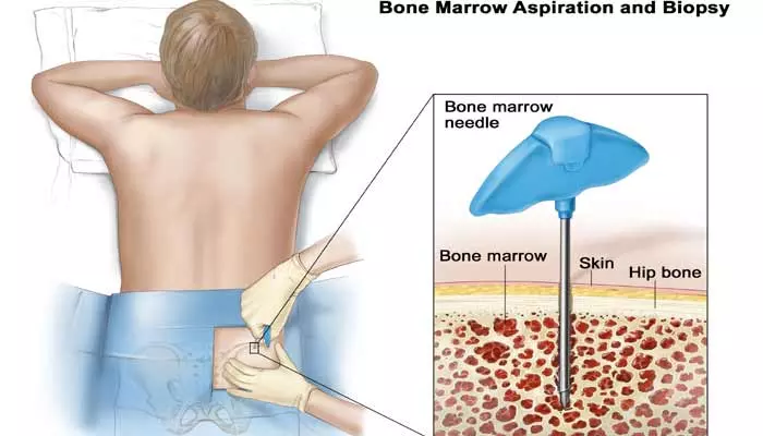 ఎముకల్ని దెబ్బతీసే మైలోమా క్యాన్సర్‌.. గుర్తించగానే ఏం చేయాలంటే..