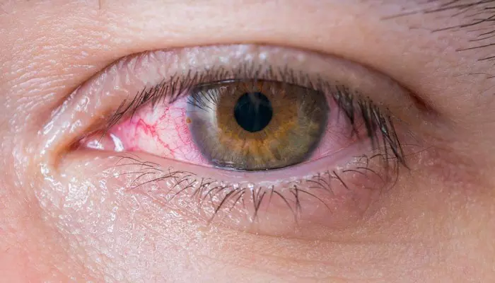 Eye Infection: Symptoms, Causes & Treatment