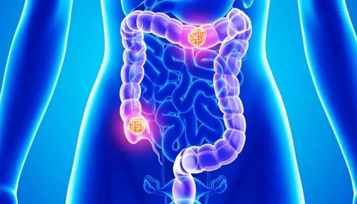 COLON CANCER : పెద్ద పేగు క్యాన్సర్ లక్షణాలు.. అస్సలు లైట్ తీసుకోవద్దు..