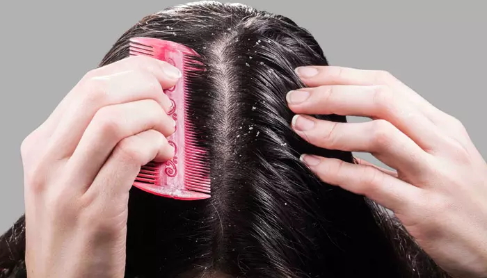 Dandruff : వేసవిలో చుండ్రు సమస్య ఎందుకు వస్తుంది?.. ఎలా నివారించాలి?