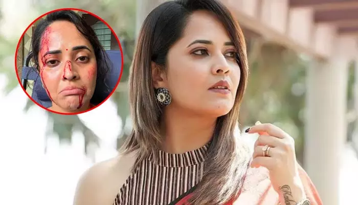 Anasuya: ముఖమంతా గాయాలతో అనసూయ.. షాకింగ్ పోస్ట్ వైరల్