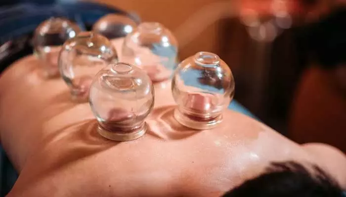 cupping therapy : కప్పింగ్ థెరపీ అంటే ఏమిటి.. చర్మం, ఆరోగ్యం రెండింటికీ ఎలా మేలు చేస్తుంది..