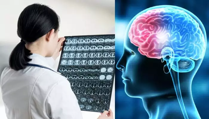 Brain stroke: పరిశోధనల్లో షాకింగ్ విషయాలు.. బ్రెయిన్ స్ట్రోక్‌కు అది కూడా కారణమే!