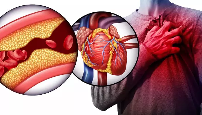 Clogged Arteries: ధమనులు బ్లాక్ అవుతున్నాయ్..! పురుషుల్లో పెరిగిపోతున్న హై కొలెస్ట్రాల్ ప్రాబ్లమ్స్!