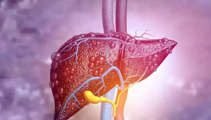 Exercises for Liver: కాలేయంలో కొవ్వు పేరుకుపోయిందా? ఇలా చేయండి