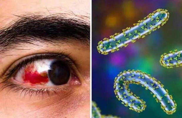 Bleeding eye virus : ముంచుకొస్తున్న ముప్పు..! ప్రాణాంతకంగా మారుతున్న బ్లీడింగ్ ఐ వైరస్