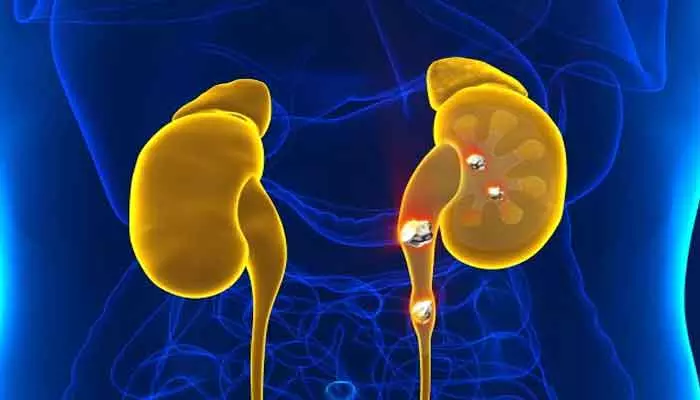 kidney stones: ఈ ఐదు రకాల కూరగాయలు తింటున్నారా.. మూత్రపిండాల్లో..